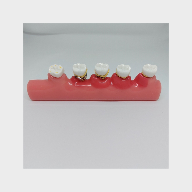 Parodontitis Studiemodel 